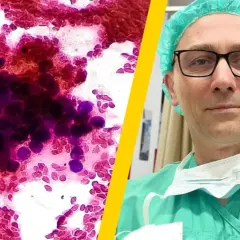 Mikroskopowy obraz komórek nowotworowych, które mogą być jednymi z najzłośliwszych nowotworów, obok lekarza w zielonym fartuchu i czepku.