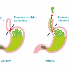 Zdrowy żołądek vs. refluks. Na ilustracji widać, jak zawartość żołądka cofa się do przełyku, gdy zwieracz jest niedomknięty.