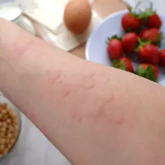 Ręka z wysypką, objawy nietolerancji jajek. W tle miska z truskawkami i jajko.
