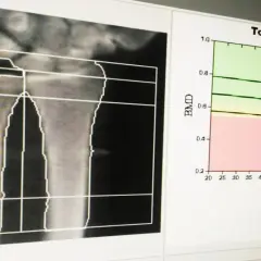 Analiza radiologiczna przedramienia z wykresem oceniającym gęstość kości w zależności od wieku.