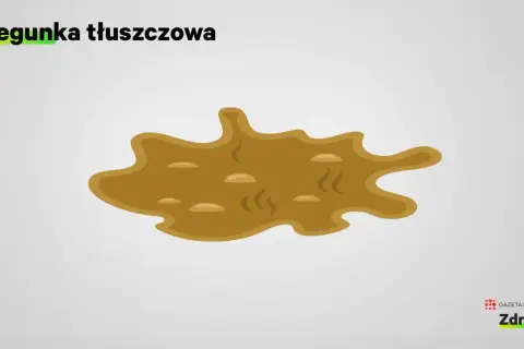 Biegunka tłuszczowa objawia się jako luźny, oleisty, kleisty stolec, często unoszący się na powierzchni wody w toalecie.