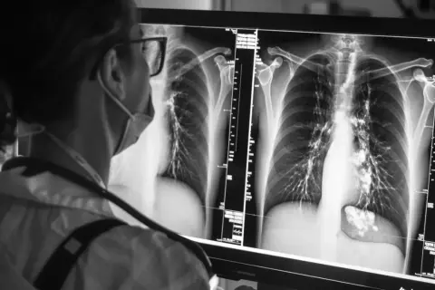 Lekarz analizuje zdjęcie RTG klatki piersiowej, szukając oznak problemów, takich jak woda w płucach.