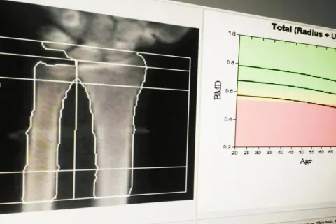 Analiza radiologiczna przedramienia z wykresem oceniającym gęstość kości w zależności od wieku.
