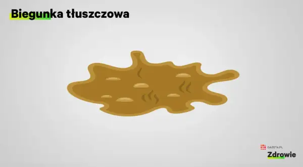 Biegunka tłuszczowa objawia się jako luźny, oleisty, kleisty stolec, często unoszący się na powierzchni wody w toalecie.