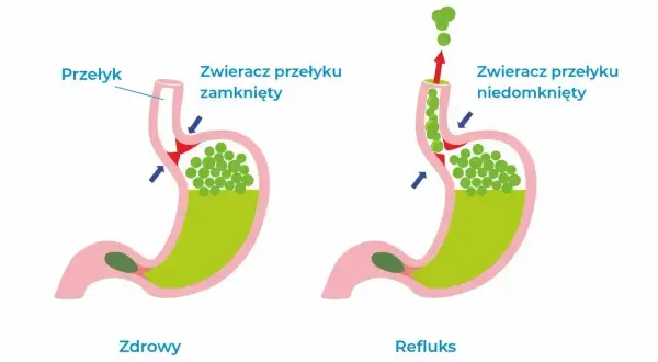 Zdrowy żołądek vs. refluks. Na ilustracji widać, jak zawartość żołądka cofa się do przełyku, gdy zwieracz jest niedomknięty.