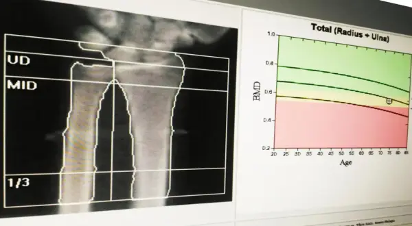 Analiza radiologiczna przedramienia z wykresem oceniającym gęstość kości w zależności od wieku.