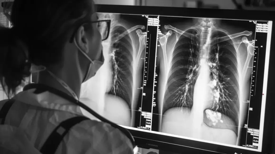 Lekarz analizuje zdjęcie RTG klatki piersiowej, szukając oznak problemów, takich jak woda w płucach.