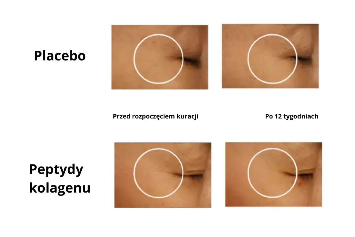 Porównanie skóry pod oczami: placebo vs. peptydy kolagenu. Widoczne zmniejszenie zmarszczek po 12 tygodniach stosowania peptydów kolagenu.