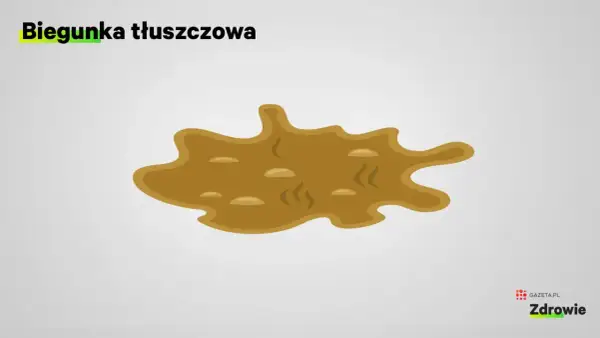 Biegunka tłuszczowa objawia się jako luźny, oleisty, kleisty stolec, często unoszący się na powierzchni wody w toalecie.