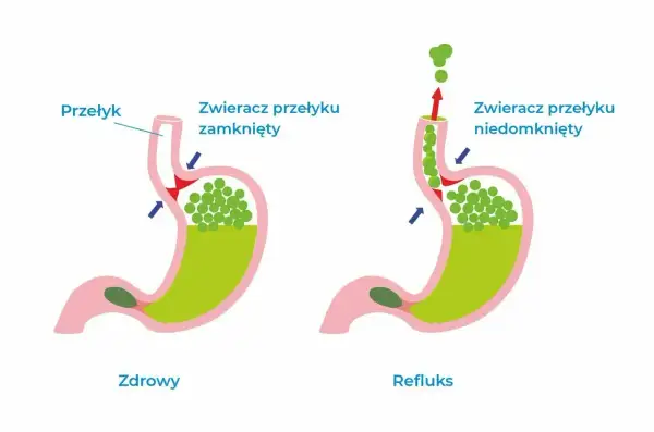 Zdrowy żołądek vs. refluks. Na ilustracji widać, jak zawartość żołądka cofa się do przełyku, gdy zwieracz jest niedomknięty.