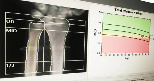 Analiza radiologiczna przedramienia z wykresem oceniającym gęstość kości w zależności od wieku.